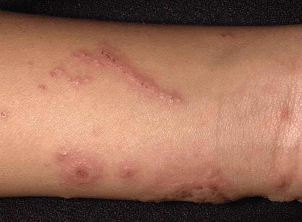 Dermatite de contact (allergique)