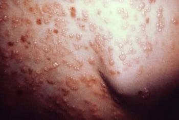 Dermatitis Herpetiformis Caused by Celiac Disease