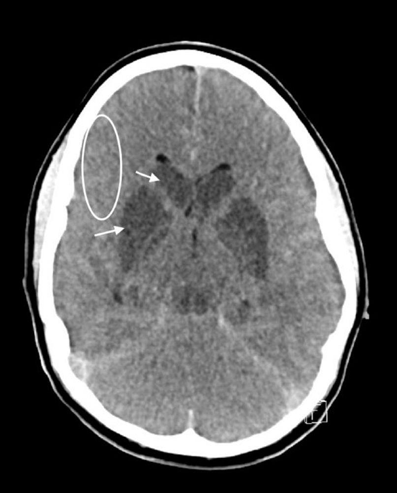 Hypoxic Ischemic Brain Injury and Cerebral Edema