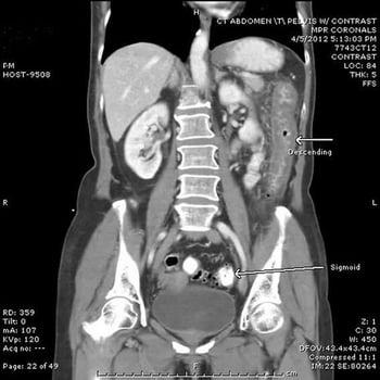 Ischemic Colitis (CT Scan)
