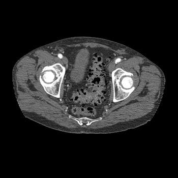 Diverticulosis (CT Scan)