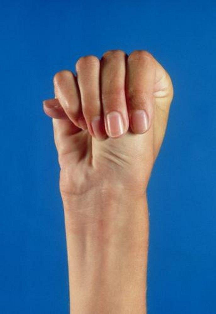 Marfan Syndrome (Thumb Sign)