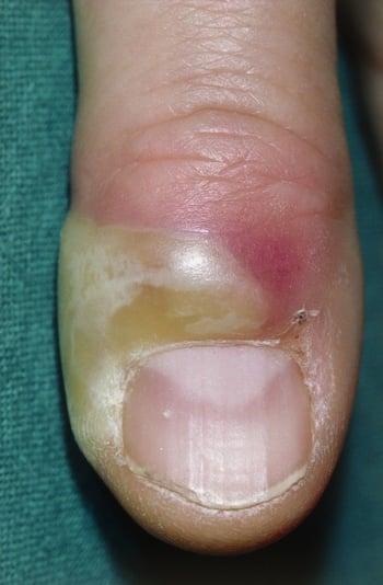 Acute Paronychia on the Finger