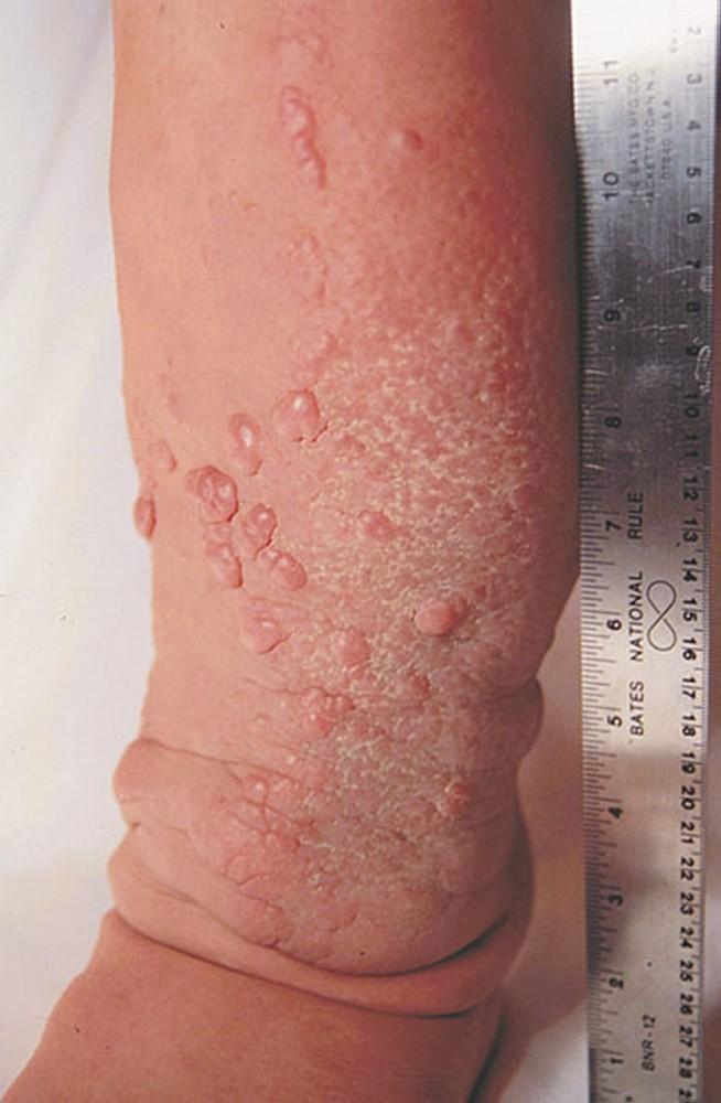 Pretibial Myxedema in a Patient With Graves Disease