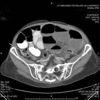 Small-Bowel Obstruction (CT Scan)