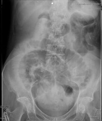 Small-Bowel Obstruction (Supine X-Ray)