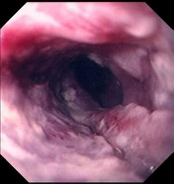 Squamous Cell Carcinoma of the Esophagus
