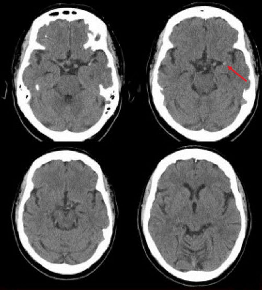 Ischemic Stroke in the Left Middle Cerebral Artery (CT)