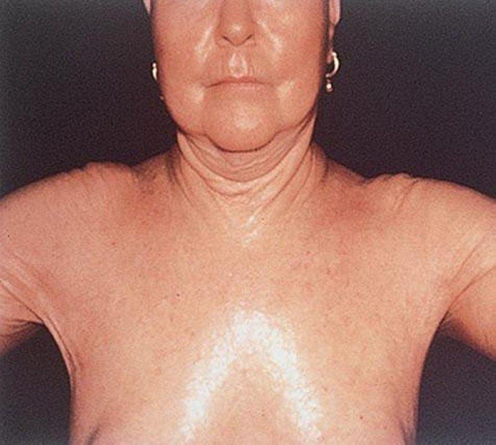 Systemic Sclerosis of the Chest and Shoulders