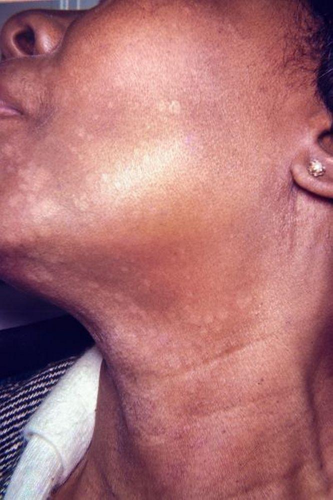 Tinea versicolor avec macules hypopigmentées et plaques sur le visage et le cou