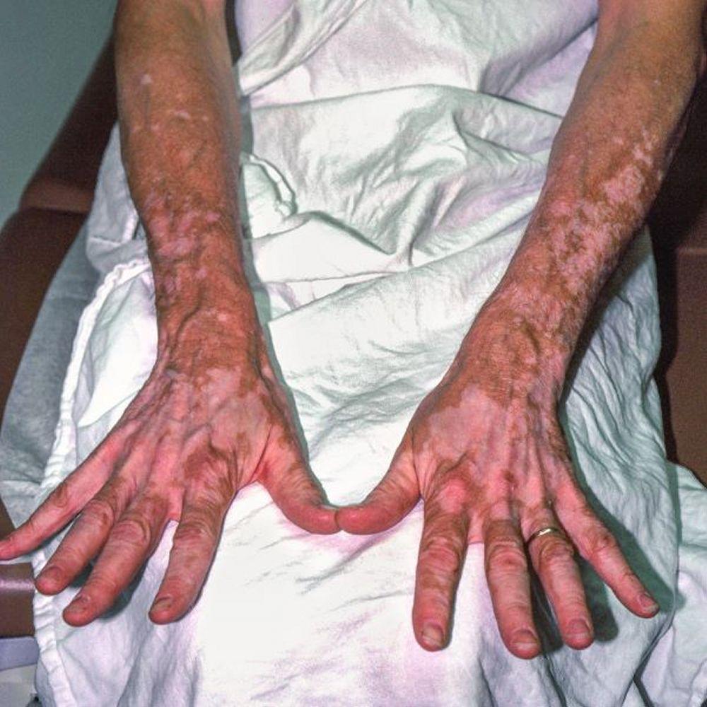 Vitiligo (mains et bras)