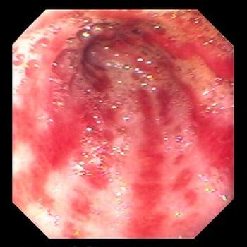 Gastric Antral Vascular Ectasia (Watermelon Stomach)