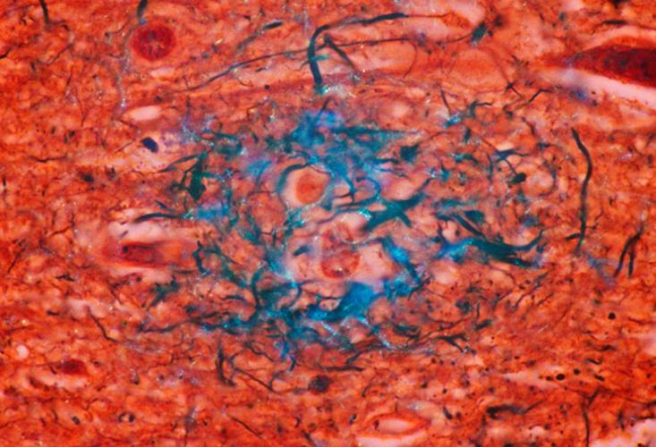 Commentary on “High-precision plasma β-amyloid 42/40 predicts current and future brain amyloidosis”