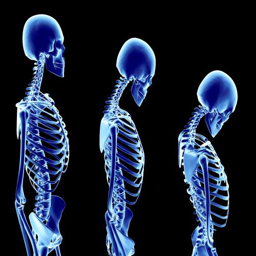 5 Things Every Person Should Know About Osteoporosis