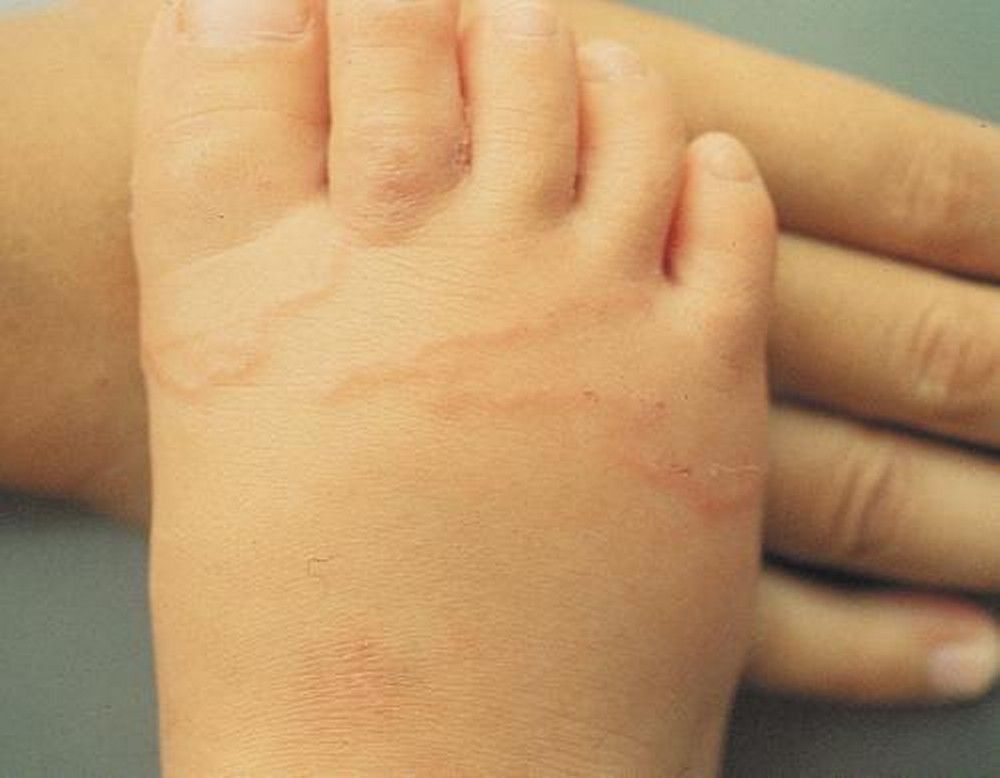 Cutaneous Larva Migrans - Skin Disorders - Merck Manuals Consumer