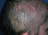 Hair-Pulling Disorder (Trichotillomania)