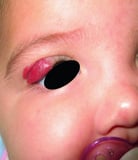 Hemangiomas of infancy (also called strawberry hemangiomas)