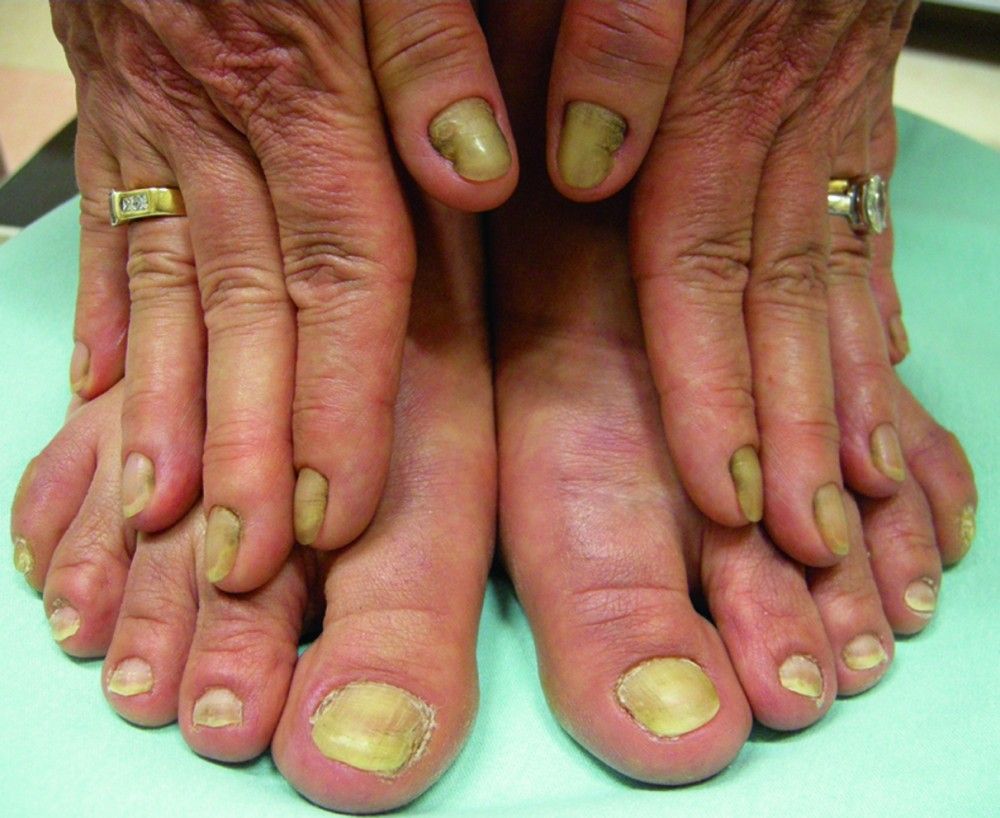 Deformities, Dystrophies, and Discoloration of the Nails - Skin Disorders -  Merck Manuals Consumer Version