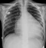 X-Rays of the Chest
