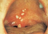 Epidemic pleurodynia (Bornholm disease)