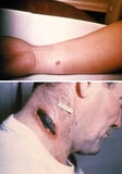 Skin anthrax (cutaneous anthrax)
