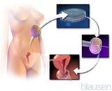 Assisted Reproductive Technologies (ARTs)