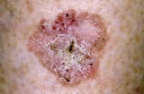 Squamous Cell Carcinoma in Situ