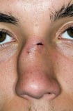 Fractures of the Nose