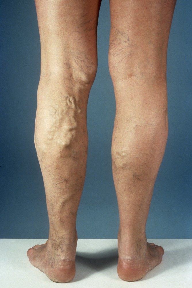 Preparate în picioare varicoase pentru tratament - Tu ce folosesti pentru a trata venele varicoase?