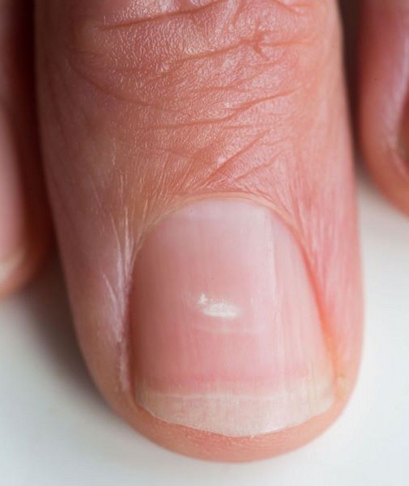 Fingernail and Toenail Injury - Skin Disorders - Merck Manuals Consumer  Version