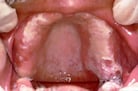 Mouth Sores and Inflammation