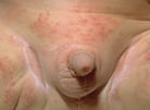 Candidiasis (Yeast Infection)
