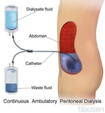 Types of Dialysis