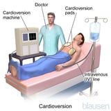 Cardioversion-Defibrillation