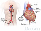 Cardiac Catheterization and Coronary Angiography