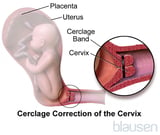 Cervical Insufficiency