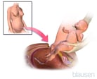 Cesarean Delivery (C-Section)