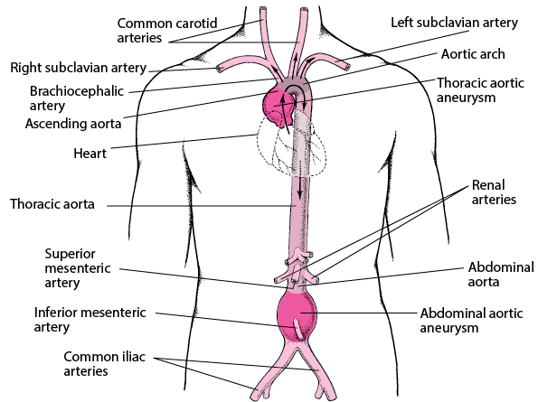Where Do Aortic Aneurysms Occur?