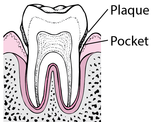 Periodontitis: From Plaque to Tooth Loss