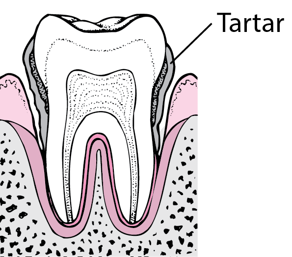 Periodontitis: From Plaque to Tooth Loss