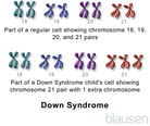 Down Syndrome (Trisomy 21)