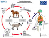 Echinococcosis (Dog Tapeworm Infection)