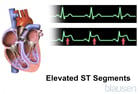 Acute Coronary Syndromes (Heart Attack; Myocardial Infarction; Unstable Angina)