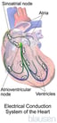 Paroxysmal Supraventricular Tachycardia (SVT, PSVT)