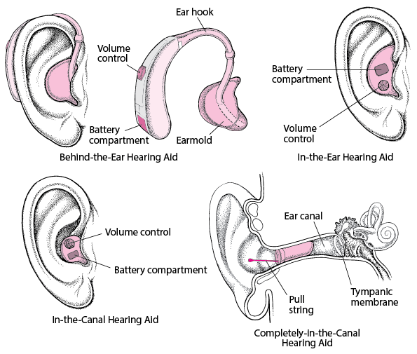 Hearing Aids: Amplifying the Sound