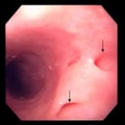 Esophageal Pouches (Diverticula)