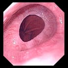 Lower Esophageal Ring