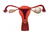 Functional ovarian cysts