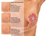 Overview of Breast Disorders