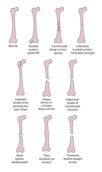 Some Types of Fractures